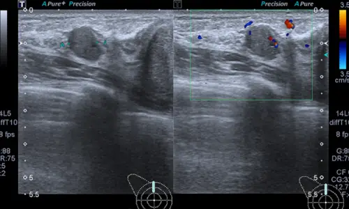 Capsule Removal? When the Cost Can Differ by About 2x (Advice from 20 Years of Research)